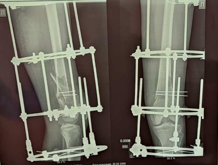 Омские медики поставили на ноги девочку со сложными переломами